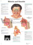 Rhinitis and Sinusitis - Anatomical Chart